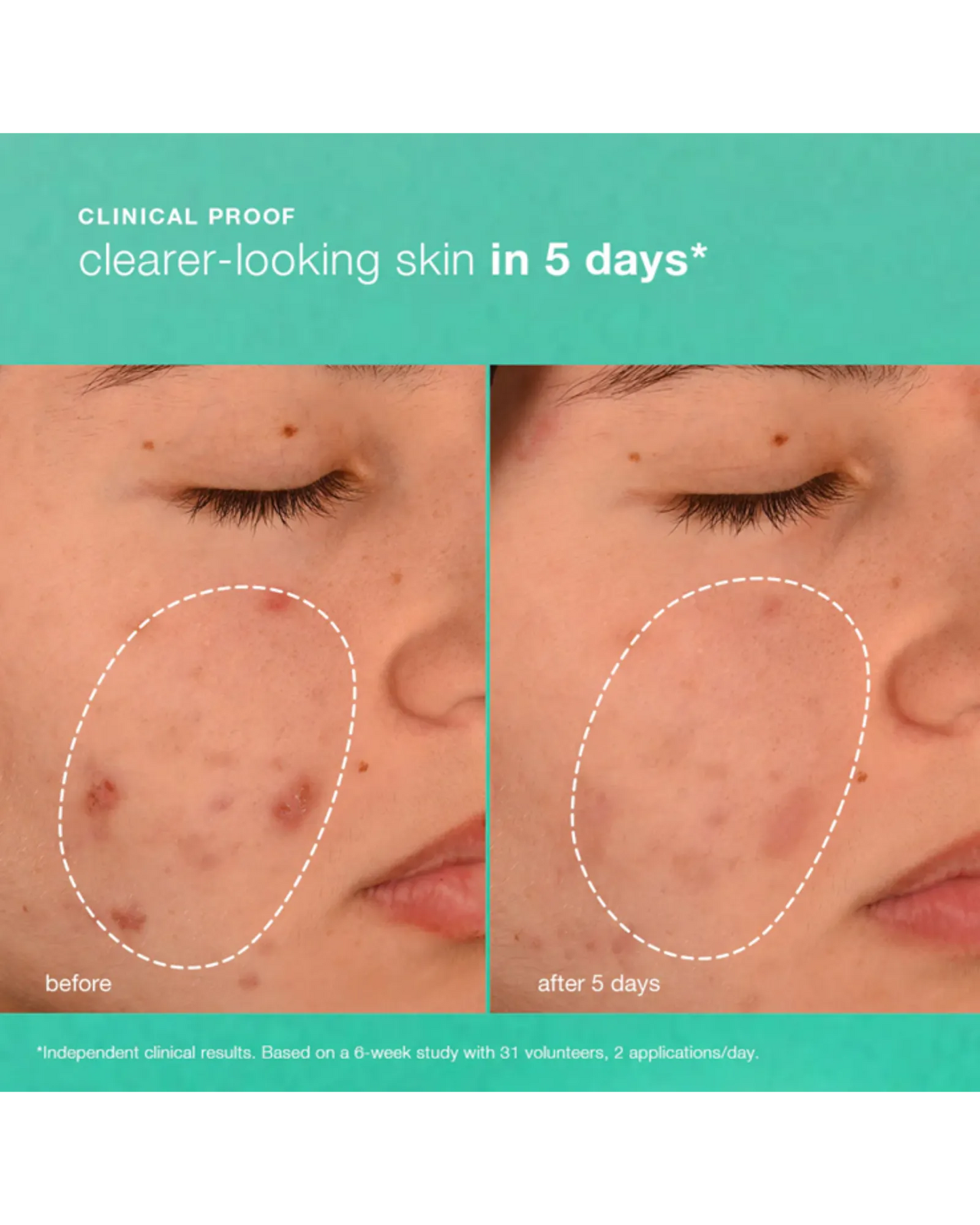 Dermalogica Breakout Biotic Moisturiser 50ml