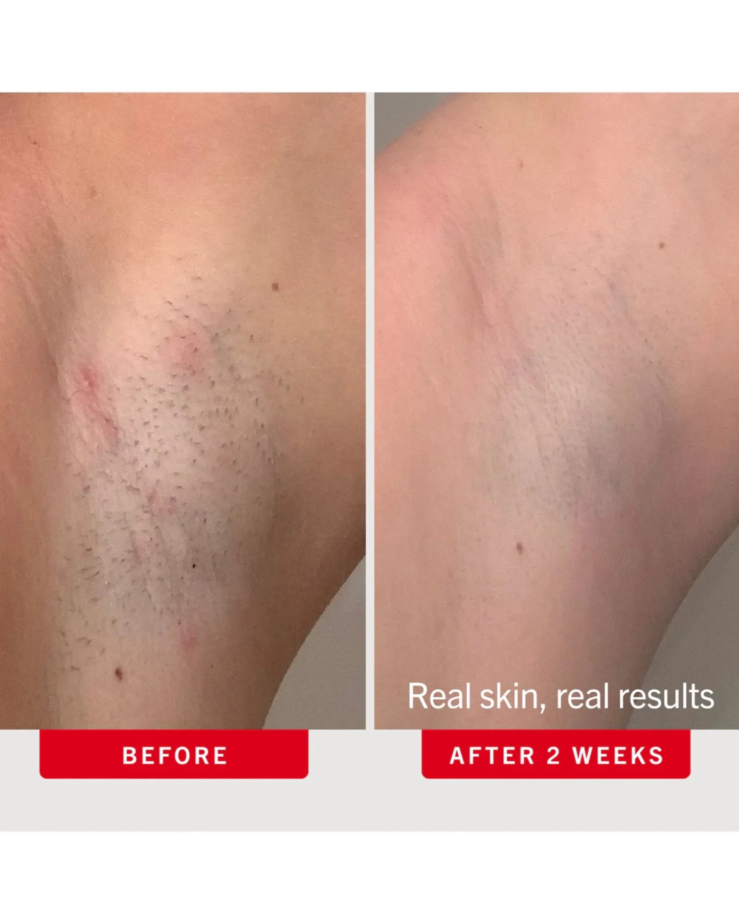 Ingrown Hair Pads with BHA + AHA 28 Pads