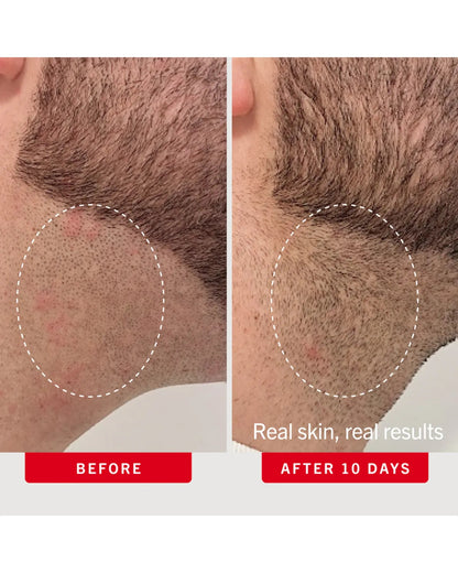 Ingrown Hair Pads with BHA + AHA 28 Pads